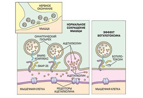 Для лечения кривошеи у взрослых применяют такой препарат как ботулотоксин