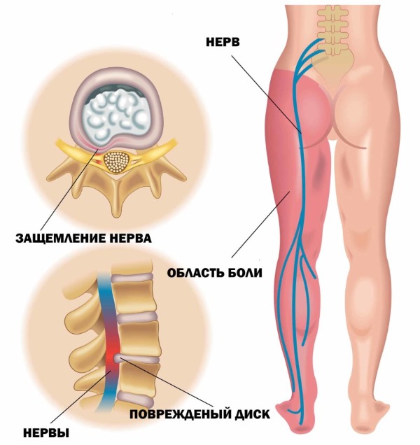 Назначают Салвисар при ишиасе, радикулите и другой невралгии