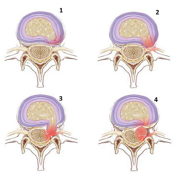 Парамедианная грыжа направлена в сторону спинного нерва