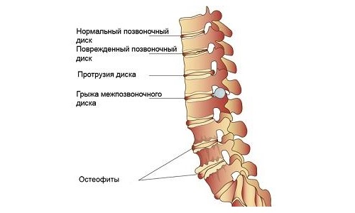 Боли в шее при поворотах могут свидетельствовать о дегенеративных изменениях в позвоночнике