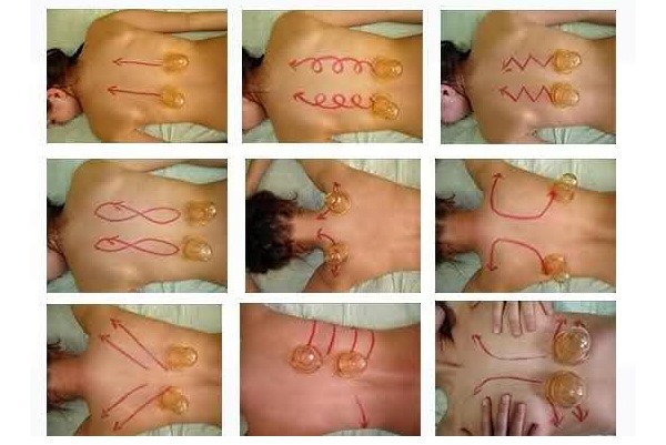 Баночный массаж способствует хорошему притоку крови к спине