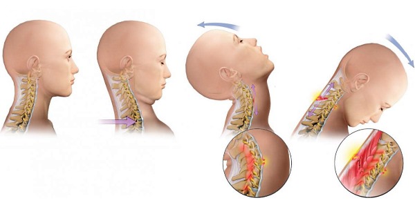 Частая травма при ДТП - хлыстообразная травма шейного отдела