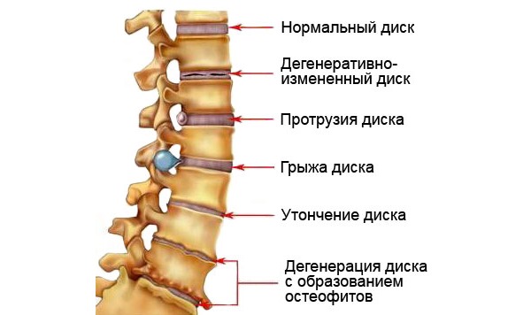 Частые причины острой боли в пояснице - дегенеративные изменения в позвоночнике