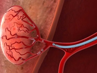 Перед удалением опухоли позвоночника в шейном отделе производят эмболизацию сосудов