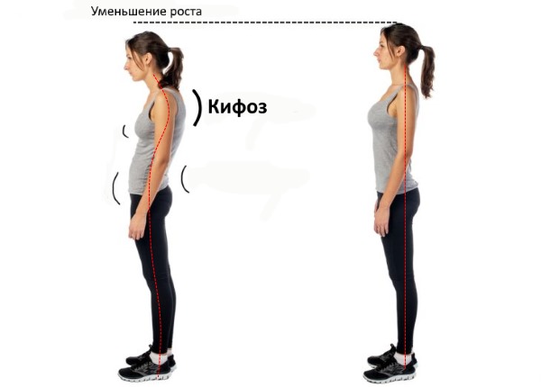Гиперкифоз грудного отдела всегда заметен со стороны, так как нарушается осанка