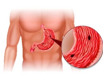 Длительное применение Династата может привести к развитию язвы желудка