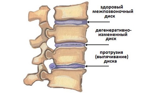 Назначают Мелоксикам Авексима при дегенративных заболеваниях суставов и позвоночника