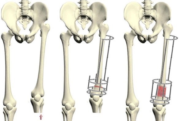 Традиционный метод удлинения конечностей предполагает ручной подкрутки имплантатов