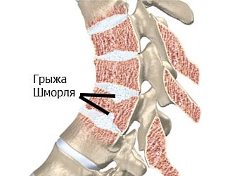 Позвоночник из-за грыжи Шморля ослабевает, так как происходит дегеративное изменение в позвонках, что приводит к различным искривлениям