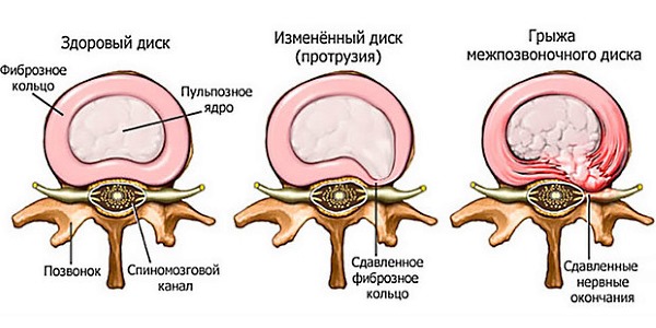 Межпозвоночная грыжа в центральной части позвоночника протекает в нескольких стадиях