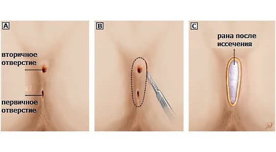 Основной метод лечения свища на копчике - хирургическое вмешательство