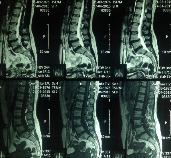Увидеть нестабильный позвоночник проще всего на снимках МРТ в положении стоя