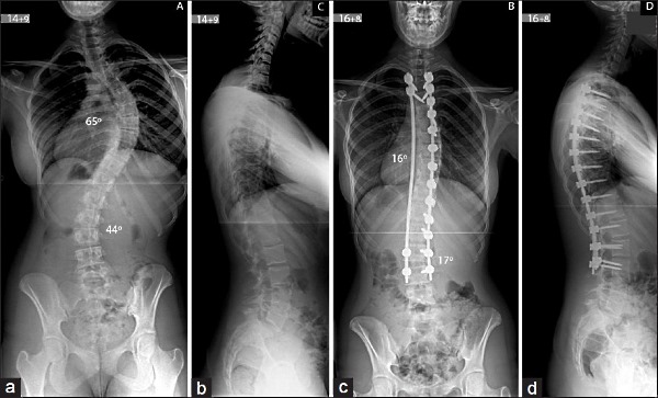 Так выглядит позвоночник до и после операции по коррекции сколиоза