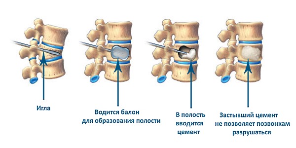 При значительных деформациях позвонков возможно назначение кифопластики