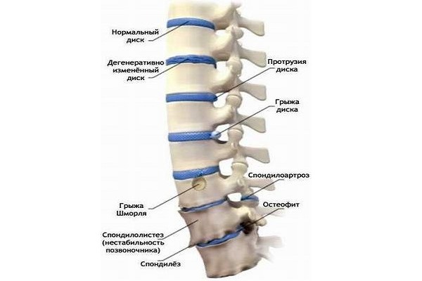 Назначают Протекон при дегенеративных заболеваниях суставов и позвоночника