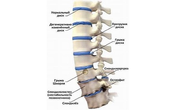Последствия происходящих дегенеративных изменений в позвоночнике