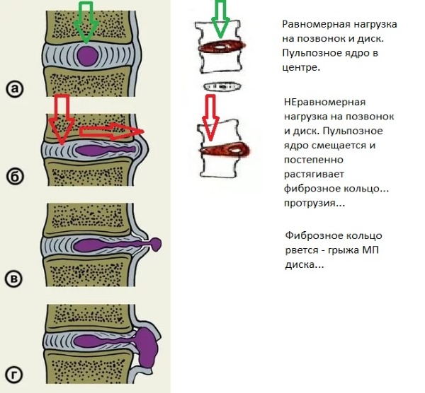 Нурофен Лонг можно использовать при болях в позвоночнике