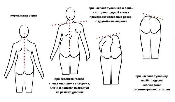 При сколиозе 2 степени анатомия спины становится несимметричной