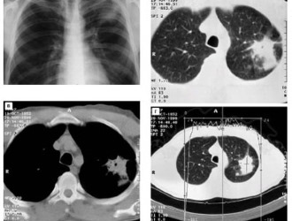 Ознакомьтесь со списком необходимых исследований при межреберной невралгии