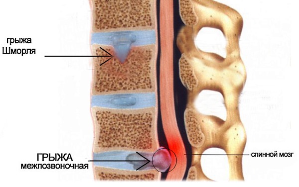 Грыжа Шморля может перерасти в обычную межпозвоночную грыжу