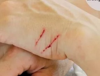 Флурбипрофен может ухудшить процесс рубцевания ран