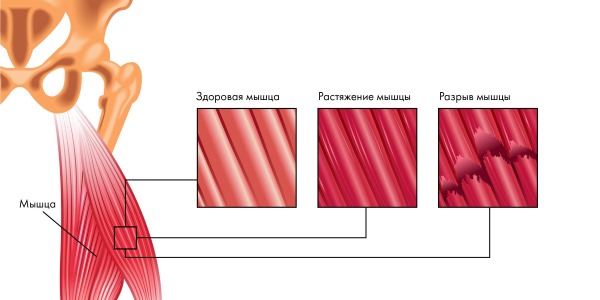 Новалгин используют для купирования боли при растяжении мышц