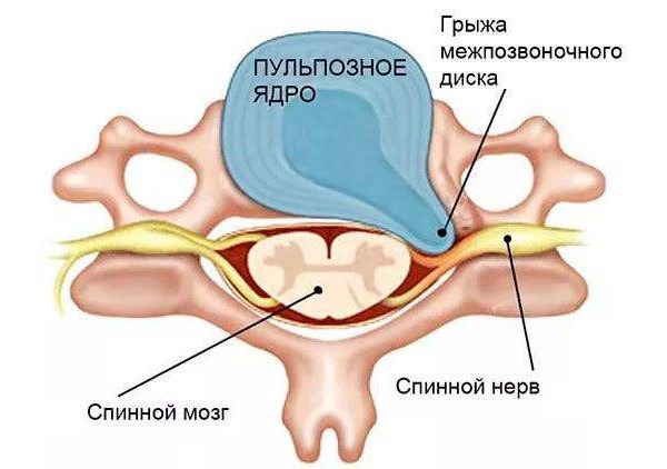 Чаще всего грыжа межпозвонкового диска возникает в задней боковой проекции