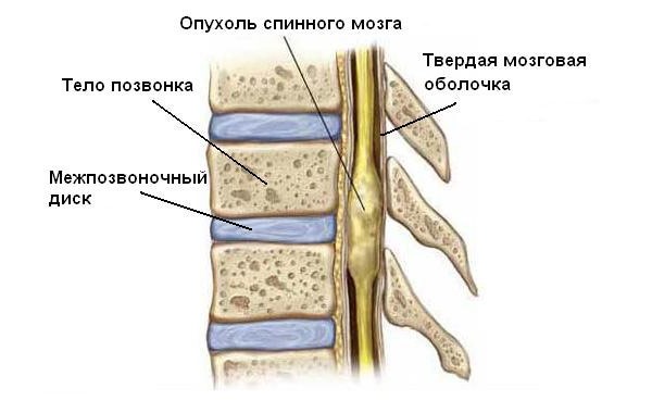 Томографию применяют при подозрении на онкологию позвоночника