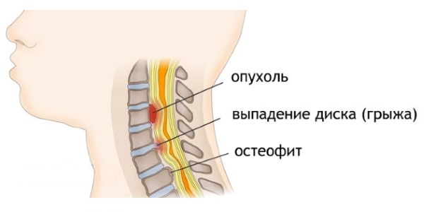 Тизанил помогает бороться с мышечными спазмами в следствии дегенеративных повреждений спинного мозга