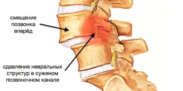 Антелистез - смещение позвонка относительно позвоночника вперед