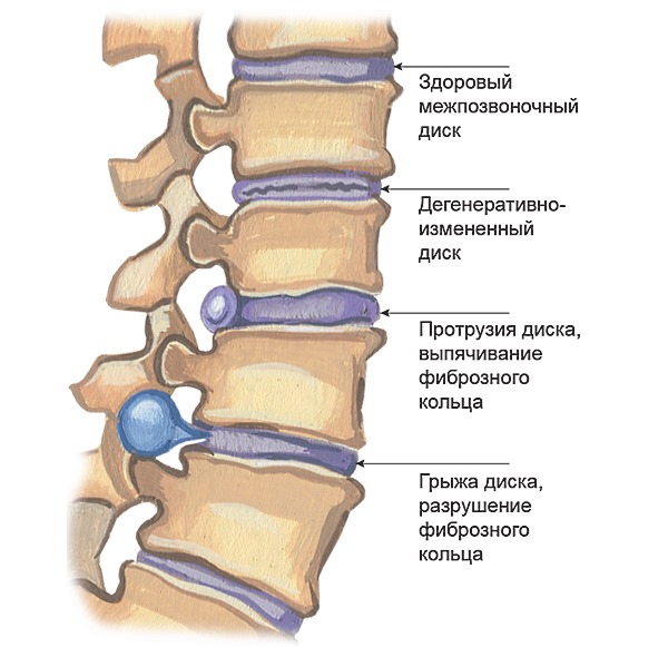 Этапы развития грыжи позвоночника