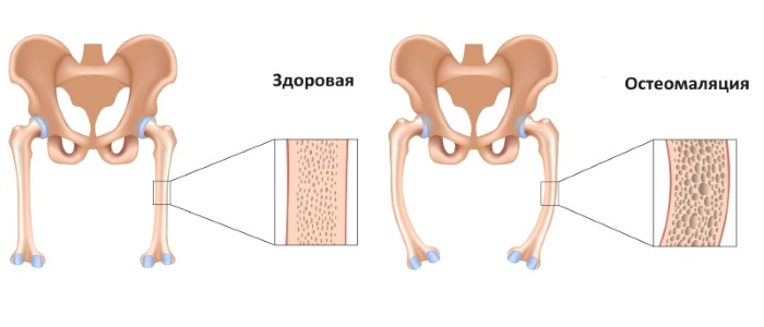 Принимают Эргокальциферол для профилактики остеомаляции