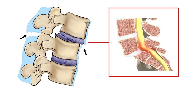 Боль при спинальной нестабильности возникает из-за корешкового синдрома