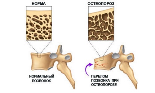 Медленно прогрессирующая компрессия позвонков является следствием остеопороза
