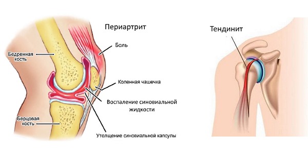 Бруфен устраняет воспаление в суставах при артритах и тендинитах