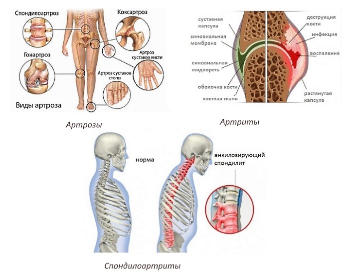 Воспалительные процессы в суставах являются прямым показанием к применению препарата Локсидол