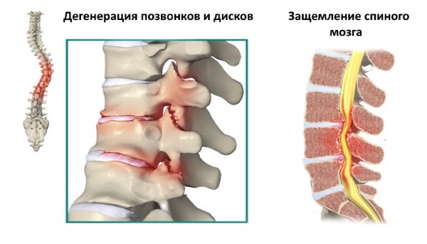 Занятия на турнике на поздних стадиях сколиоза могут спровоцировать повреждения позвоночника