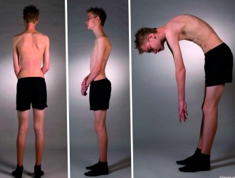 При кифозе занятия ЛФК практически не имеют противопоказаний