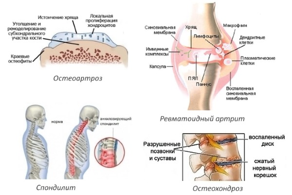 Заболевания, при которых назначают Мовасин