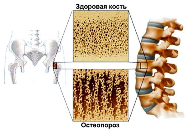 При остеопорозе костная ткань имеет рыхлую структуру