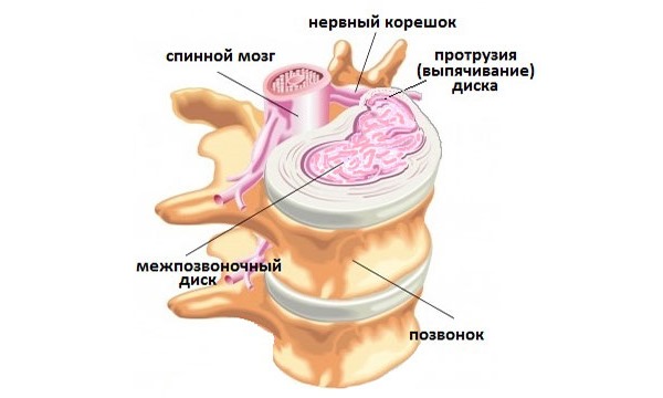 Протрузия диска в грудном отделе достаточно редкое явление