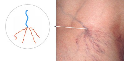 проявление сосудистых звёздочек