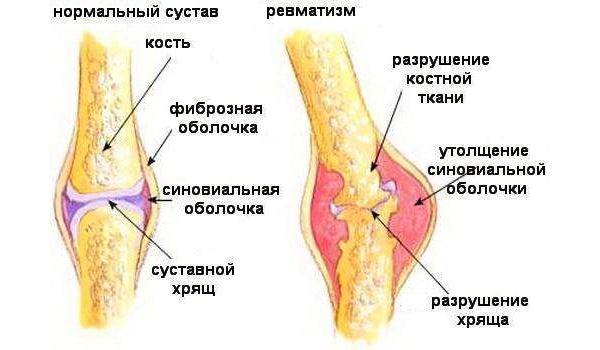 Из-за фармакологических особенностей активного вещества Нурофена Экспресс Нео лекарство назначают при ревматизме