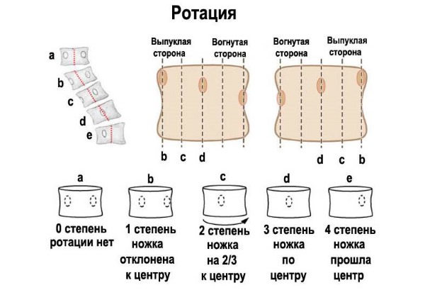 Ротация позвонков протекает в 5 стадиях
