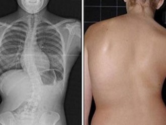 Список ограничений при сколиозе зависит от степени деформации грудной клетки