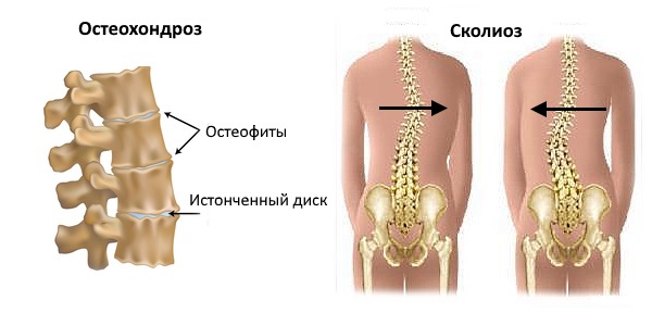 Остеохондроз и сколиоз - самые распространенные заболевания позвоночника