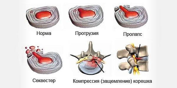 Стадии развития межпозвоночной грыжи
