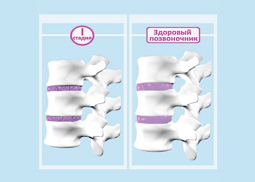 Обратите внимание на признаки первой стадии остеохондроза