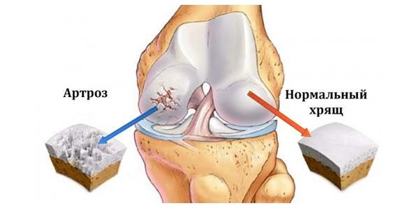 Врач может назначать Структум людям с повреждением хрящевой ткани в суставах