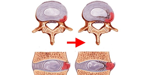 Проводить массаж лучше всего на начальных стадиях межпозвоночной грыжи, когда еще не произошло выпадение диска